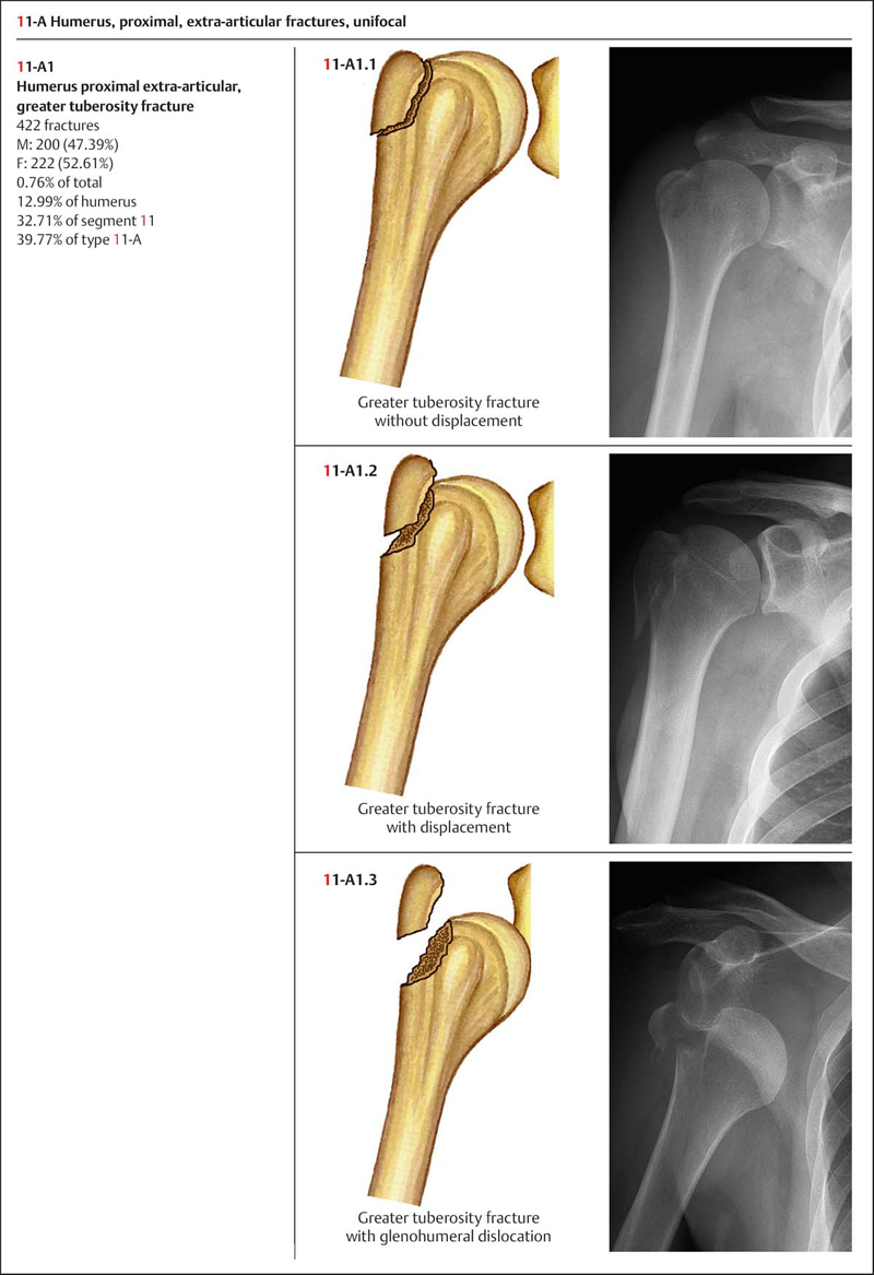 humeral neck fracture