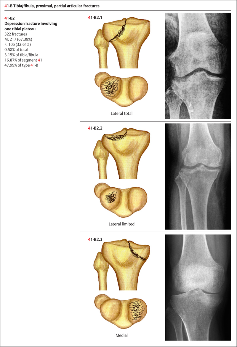 tib fib fracture classification