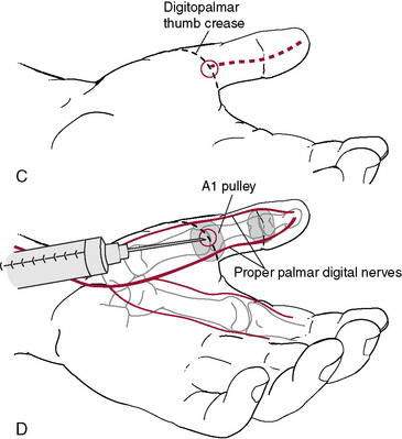 trigger injection finger flexor hand tenosynovitis ultrasound cortisone
