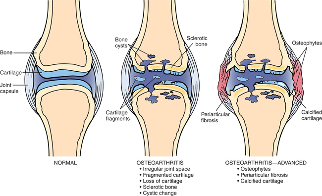 Rheumatic Disorders | Musculoskeletal Key