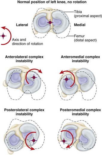 Knee Injuries | Musculoskeletal Key