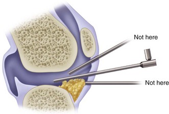 General Principles Of Arthroscopy | Musculoskeletal Key