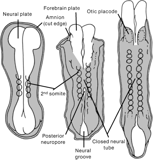 Spina Bifida A Congenital Spinal Cord Injury Musculoskeletal Key