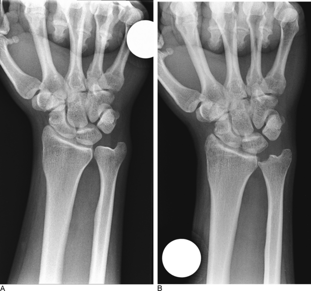 Class IIA And B Ulnar Impaction: Treatment With Arthroscopic TFCC Disc ...