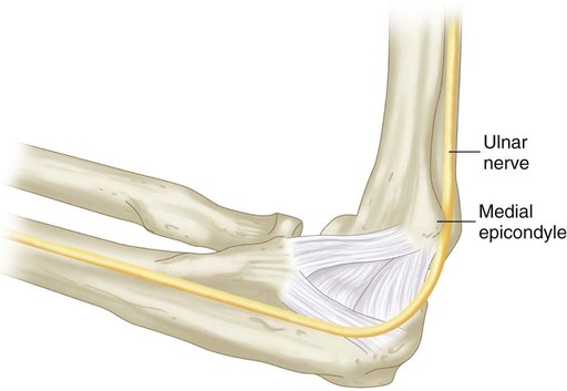 4: Open Reduction and Internal Fixation of Displaced Medial Epicondyle ...