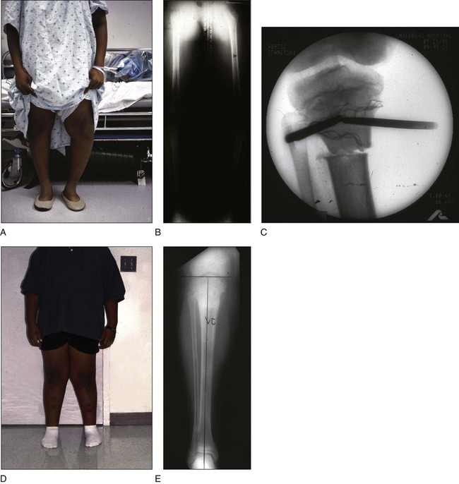 29: Epiphysiodesis Of The Distal Femur/Proximal Tibia-Fibula ...