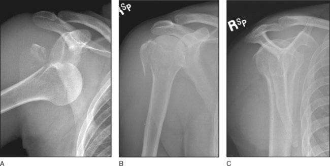 3: Proximal Humerus Fractures | Musculoskeletal Key