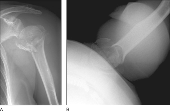 right proximal humerus fracture