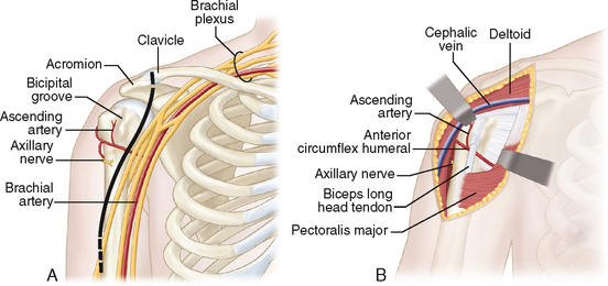 3: Proximal Humerus Fractures | Musculoskeletal Key