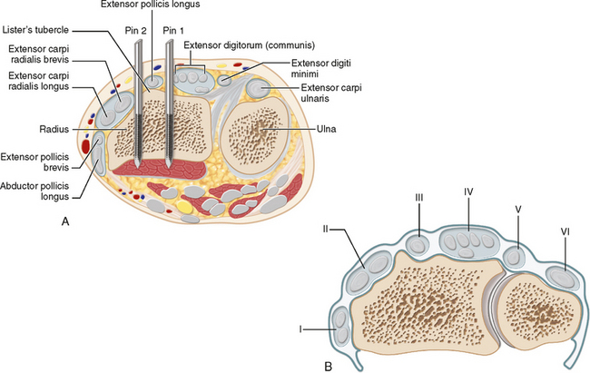 13: Distal Radius Fractures | Musculoskeletal Key