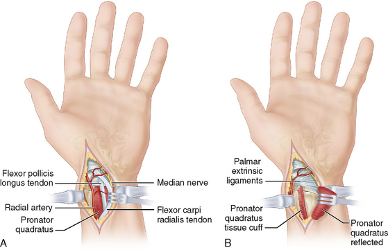 14: Distal Radius Fractures | Musculoskeletal Key