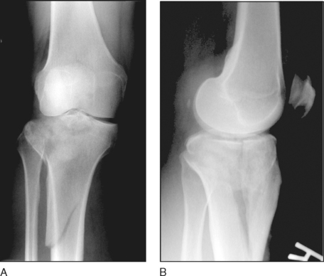 30: Proximal Tibia Fractures: External Fixation I | Musculoskeletal Key