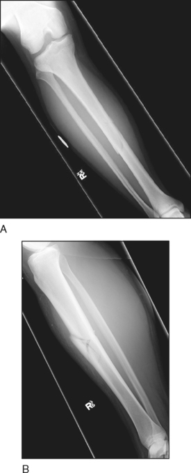 31 Tibial Shaft Fractures Musculoskeletal Key