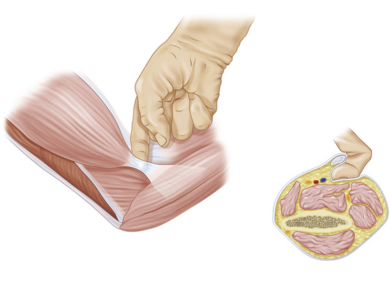 Supination Pronation Test  Distal Biceps Tendon Rupture