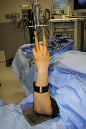 Wrist Arthroscopy: Setup, Anatomy, and Portals | Musculoskeletal Key