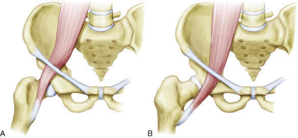 Internal Snapping Hip Syndrome | Musculoskeletal Key