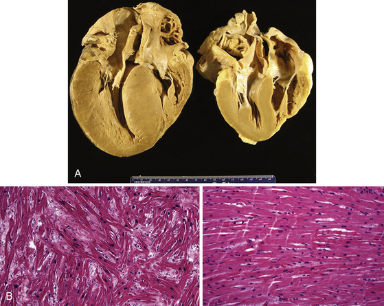 Ventricular Arrhythmias in Hypertrophic Cardiomyopathy | Musculoskeletal Key