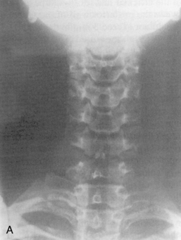 x ray images cervical spine