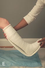 Splinting and casting | Musculoskeletal Key