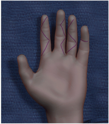 Surgical Approaches To The Digits And Treatment Of Finger Infections