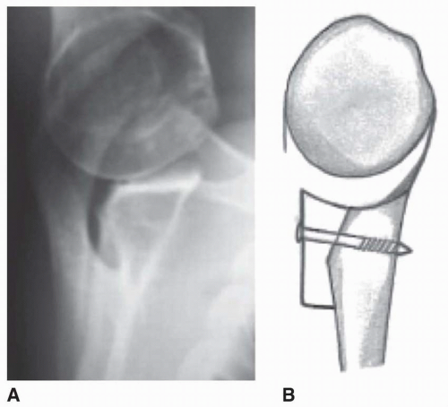 Decision Making And Performance Of Digital Ray Amputation ...