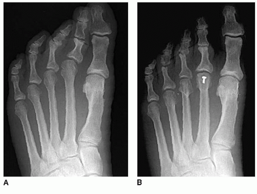 Weil Osteotomy And Dorsal Approach Plantar Plate Repair ...