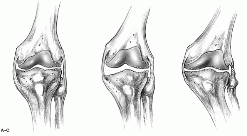 Managing Medial Collateral Ligament Deficiency with Soft Tissue