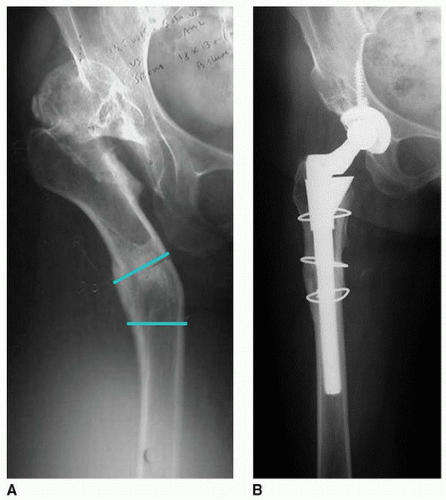 Total Hip Arthroplasty In Patients With Proximal Femoral Deformity ...