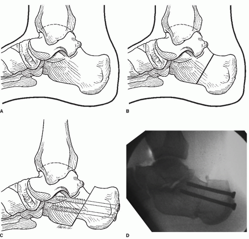 Decision Making And Performance Of Digital Ray Amputation ...