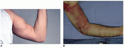 Repair of Distal Biceps Tendon Rupture Musculoskeletal Key