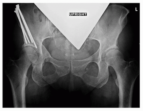 Periacetabular Osteotomy | Musculoskeletal Key