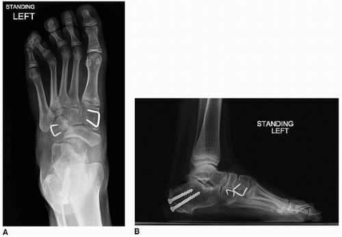 Cavus Foot Reconstruction | Musculoskeletal Key