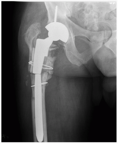Extensively Porous-Coated Cylindrical Uncemented Femoral Stems ...