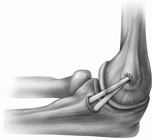 Surgical Techniques for Failed Medial Ulnar Collateral Ligament ...