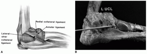Ulnar Collateral Ligament Repair