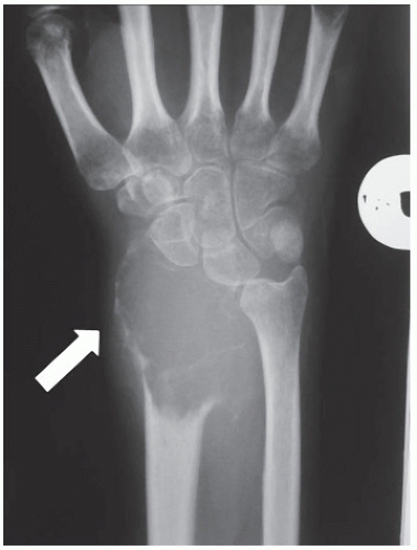 Distal Radius Osteoarticular Allograft Musculoskeletal Key 7068