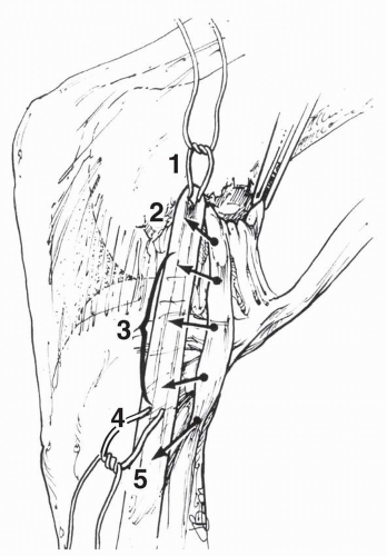 Surgical Management Of Medial Collateral Ligament Injuries ...