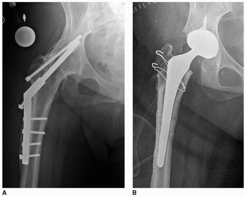 Conventional Trochanteric Osteotomies and the Trochanteric Slide ...