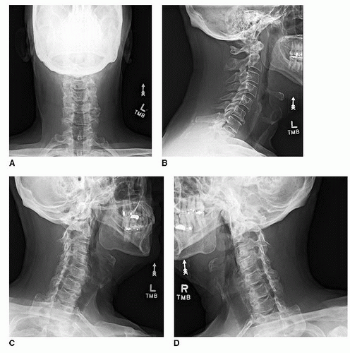 Posterior Cervical Microdiscectomyforaminotomy Musculoskeletal Key 9390