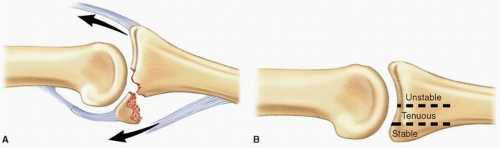 Operative Management Of PIP Dislocations And Fracture-Dislocations ...