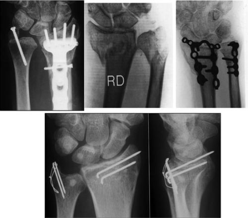 Distal Radius Fractures: Open Reduction Internal Fixation ...