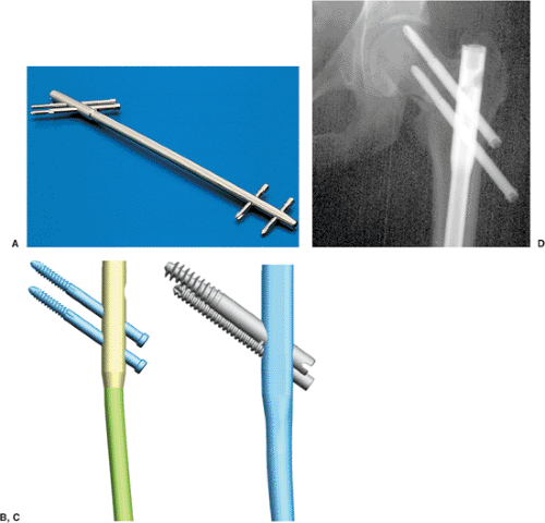 Subtrochanteric Femur Fractures: Reconstruction Nailing | Musculoskeletal  Key