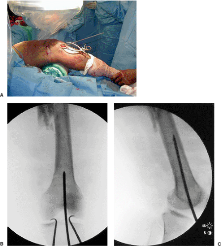 Early postoperative radiography [anteroposterior (AP) and lateral views] |  Download Scientific Diagram