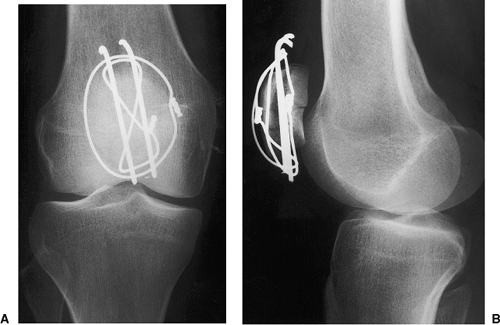 Patellar Fractures: Open Reduction Internal Fixation | Musculoskeletal Key