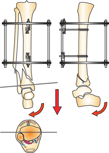 Fixation of ring fixator to proximal tibia. (a) Transverse wire