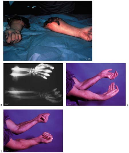 Management Of Major Upper Limb Amputation | Musculoskeletal Key