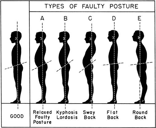 Analyzing Bad Posture and The Increased Likelihood of Falls in