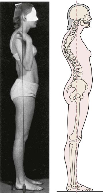 A) Normal posture. (B) Slouched posture. (C) Upright posture