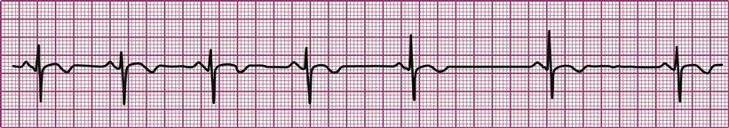 Cardiac Arrhythmias And Conduction Disturbances Musculoskeletal Key