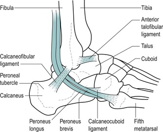 peroneal tubercle of calcaneus
